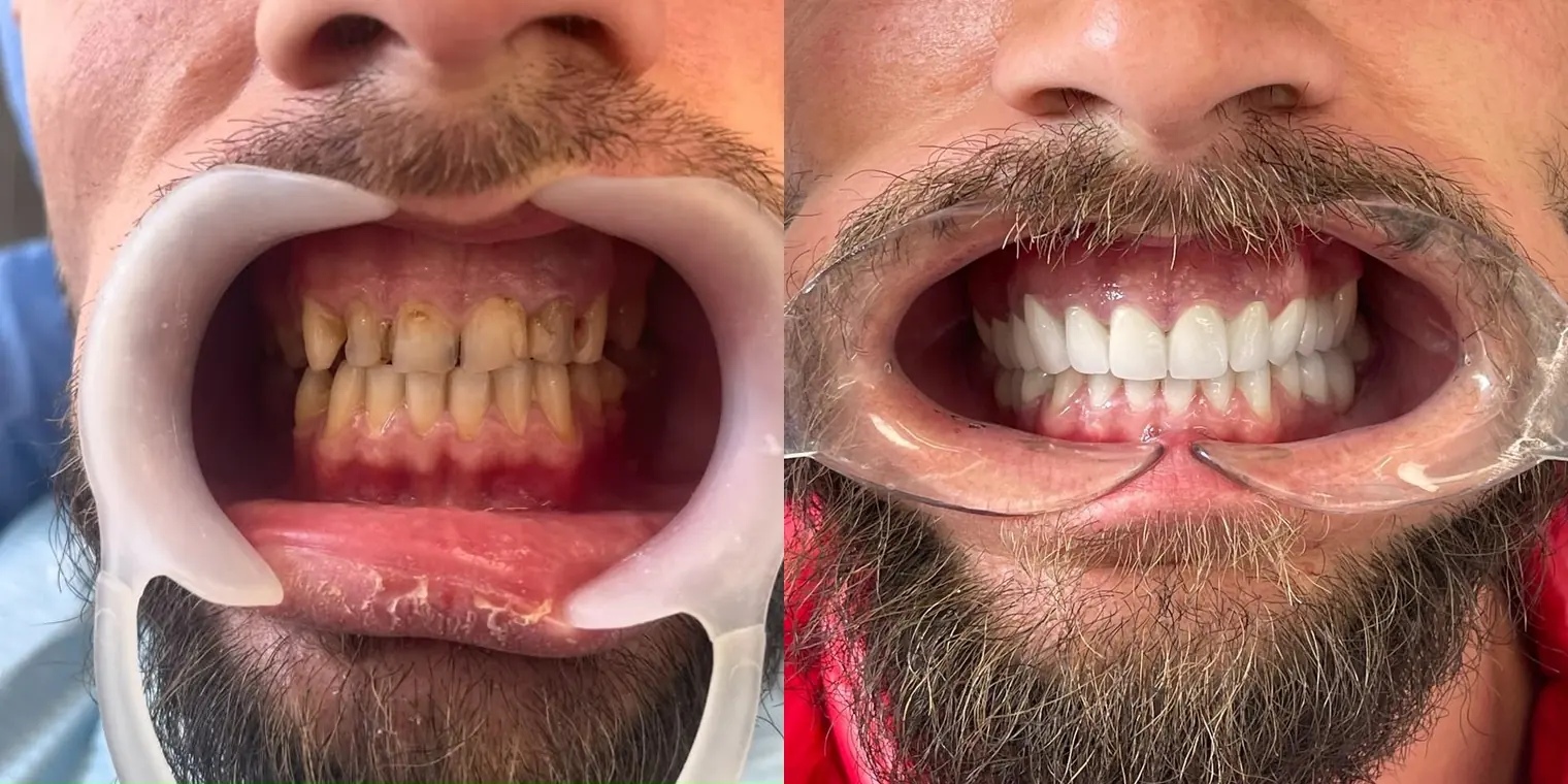 Case 01 real patient before and after dental treatment