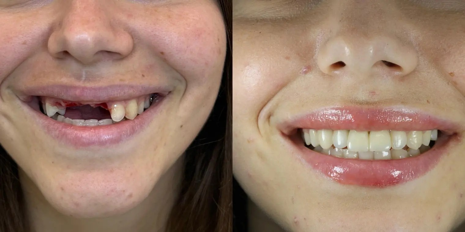 Case 02 real patient before and after dental treatment